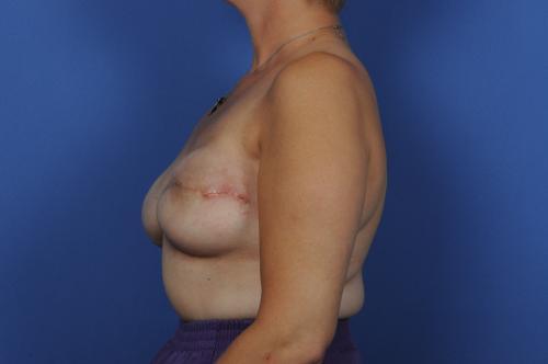 Breast Reconstruction Revision Before & After Image
