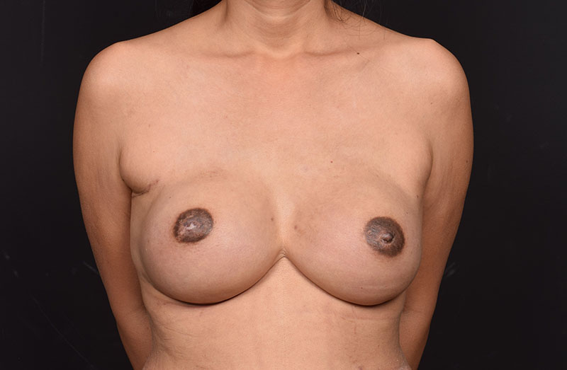 Nipple Sparing Mastectomy Before & After Image