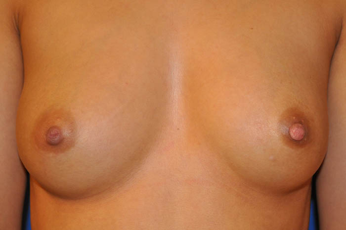 Inverted Nipple Repair Before & After Image