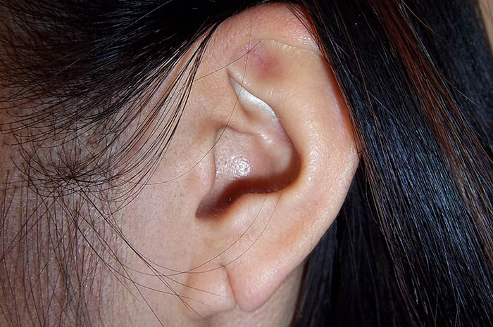 Ear Lobe Repair Before & After Image