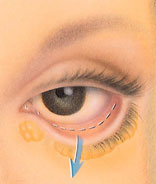 Blepharoplasty in Portland oregon