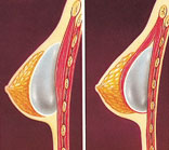 Breast Augmentation Portland