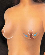 Breast Lift Portland Oregon