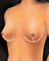 Breast Implant Portland Oregon