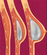 Portland Breast Reconstruction with tissue expander diagram