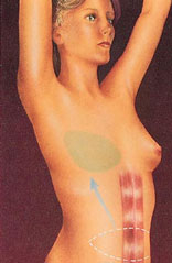 Flap Breast Reconstruction Diagram