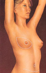 Breast Reconstruction Diagram