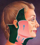 Facelift Surgical procedure Portland