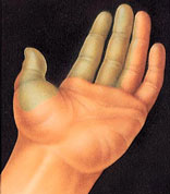 Hand Surgery Portland