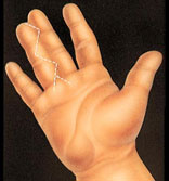 Hand Surgery Portland