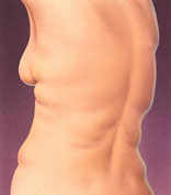 Portland Liposuction surgical procedure