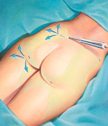 Liposuction Portland Oregon