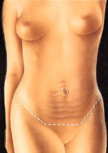 Portland Tummy tuck surgical procedure