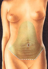 Tummy Tuck Portland Oregon