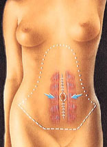 Portland Tummy tuck with Dr Sam Bartholomew