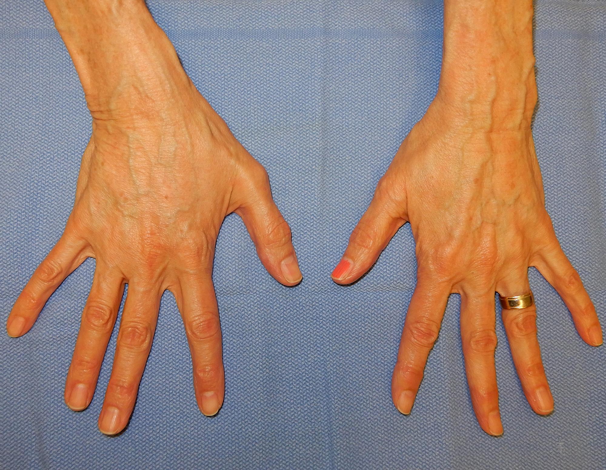 Hand Fat Grafting Before & After Image