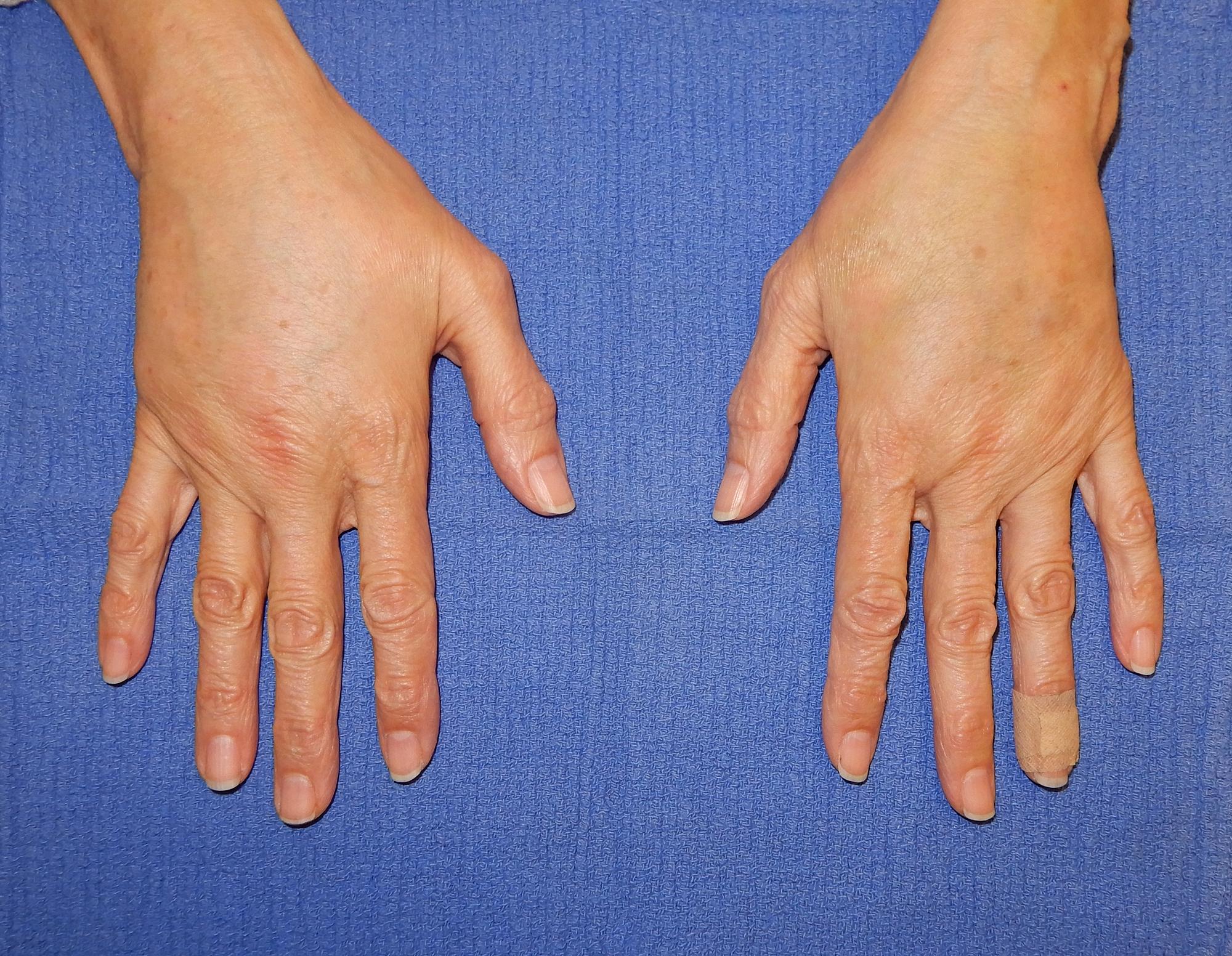 Hand Fat Grafting Before & After Image