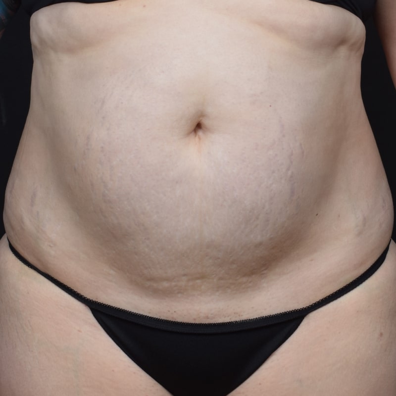 Liposuction Before & After Image