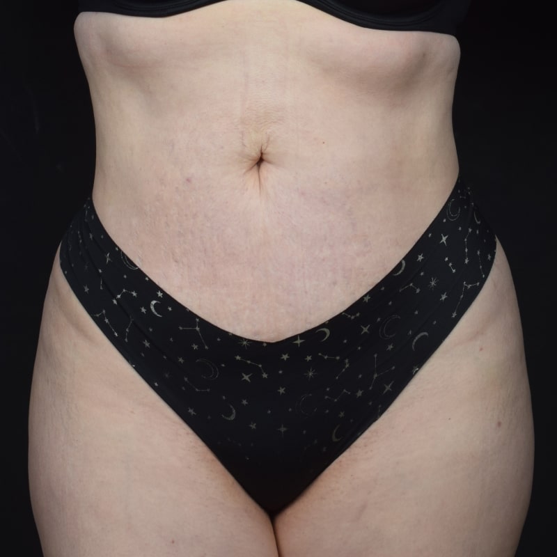 Liposuction Before & After Image