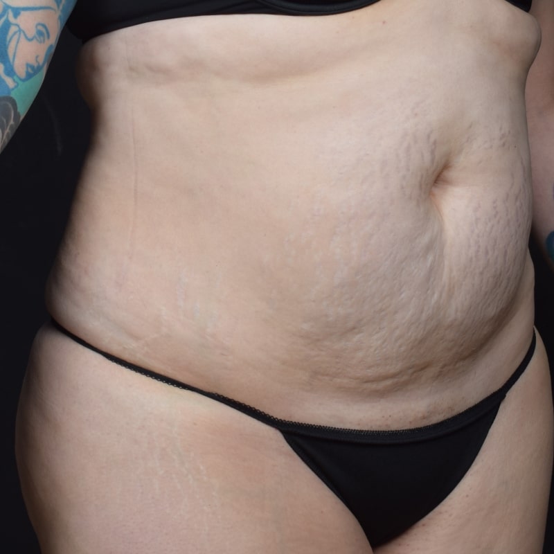 Liposuction Before & After Image