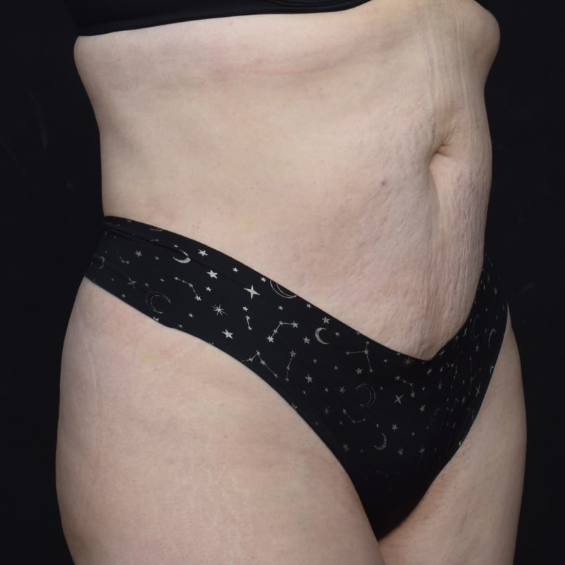 Liposuction Before & After Image