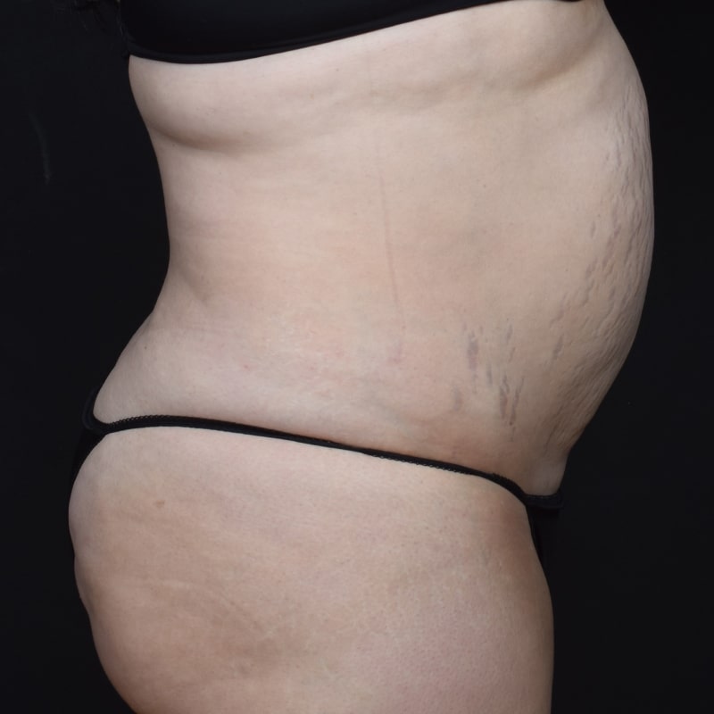 Liposuction Before & After Image