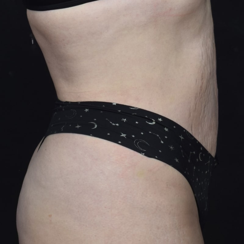 Liposuction Before & After Image