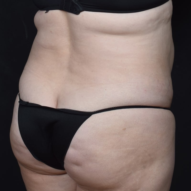 Liposuction Before & After Image