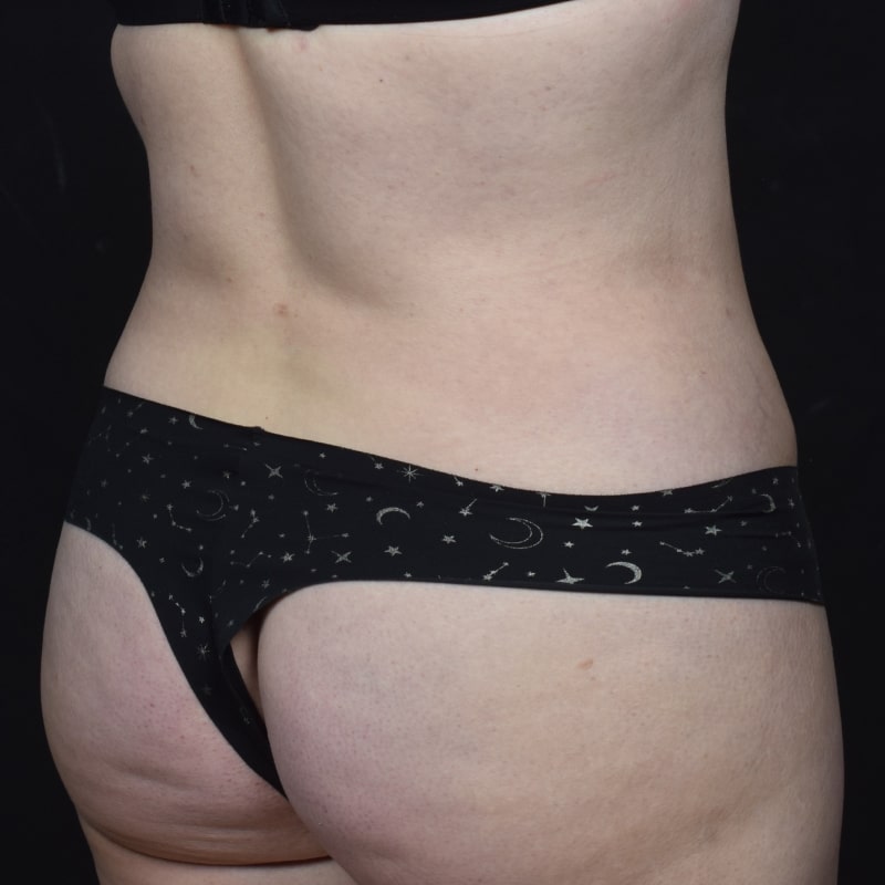 Liposuction Before & After Image