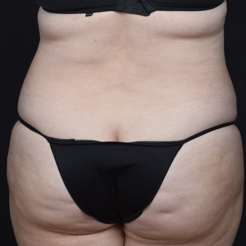 Liposuction Before & After Image