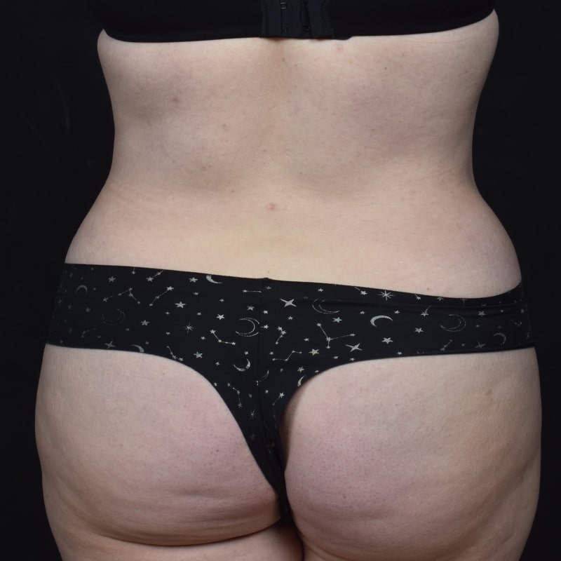 Liposuction Before & After Image