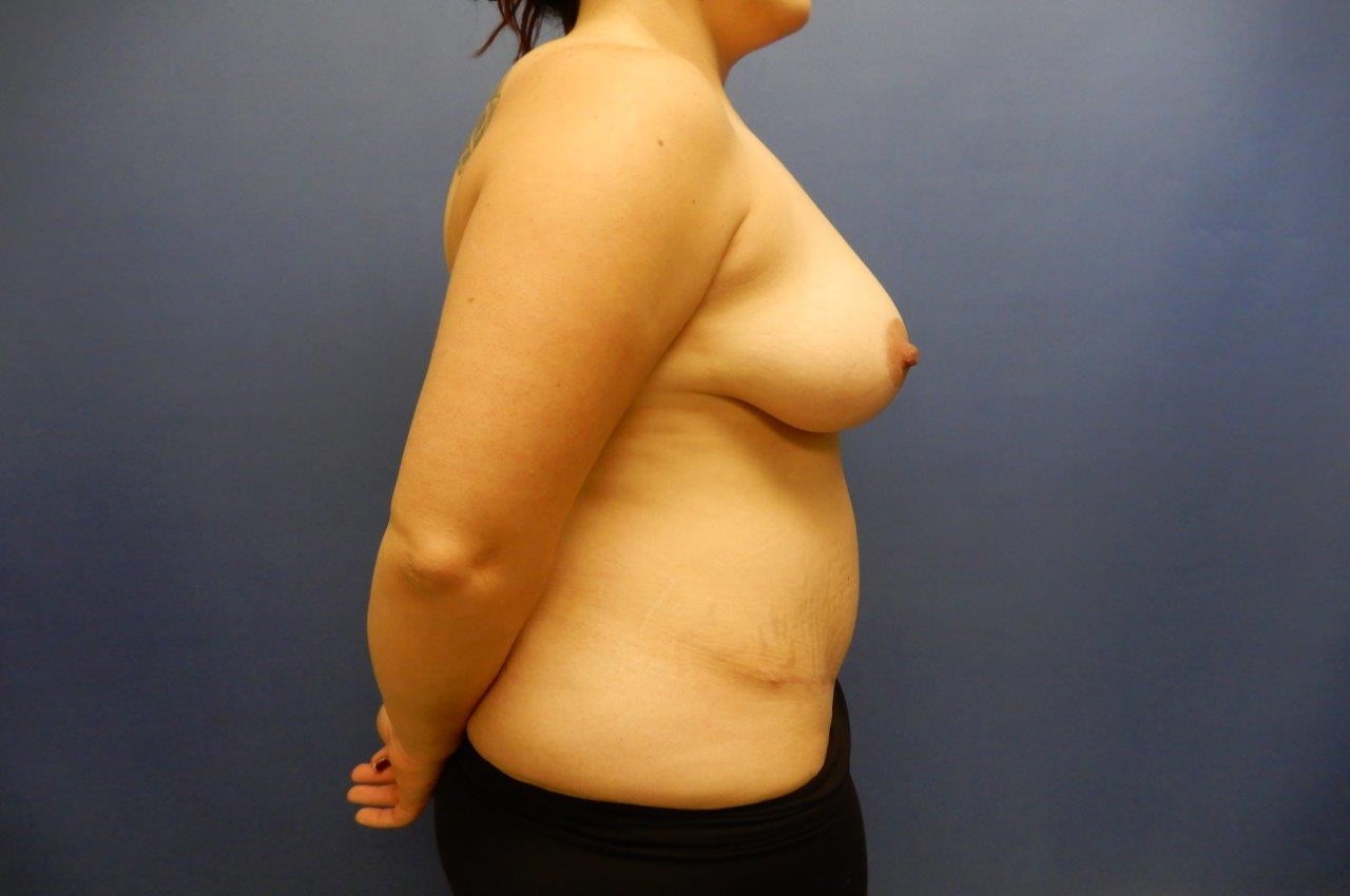 Liposuction Before & After Image