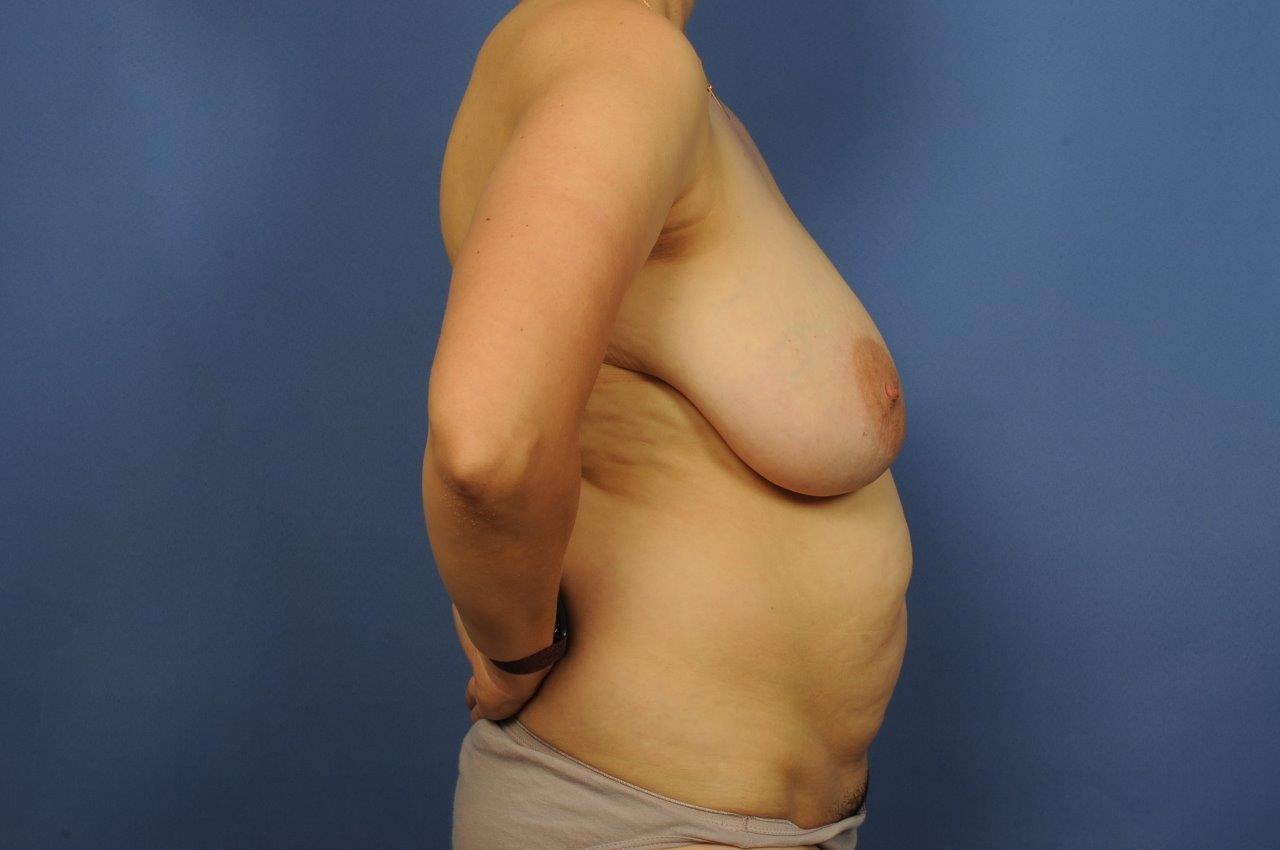 Liposuction Before & After Image