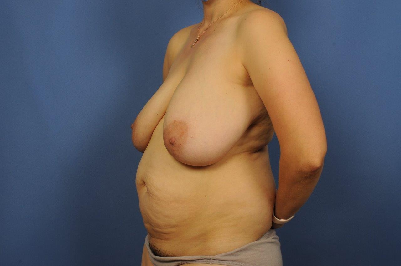 Liposuction Before & After Image