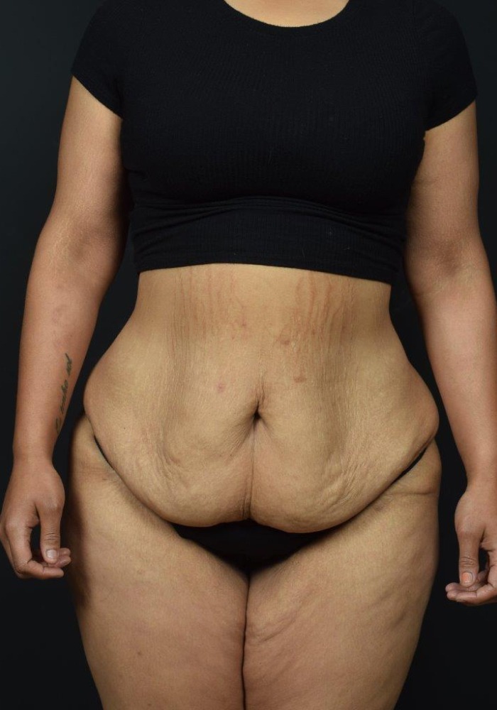 Liposuction Before & After Image