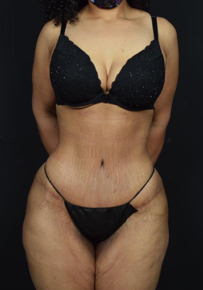 Liposuction Before & After Image