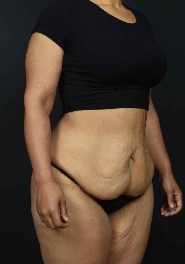 Liposuction Before & After Image