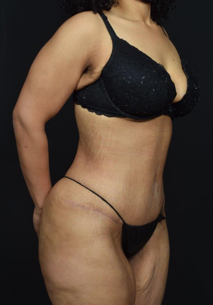 Liposuction Before & After Image