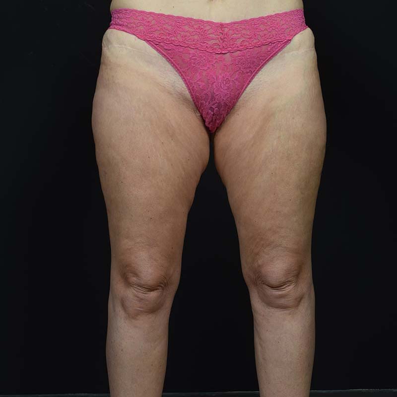 Thigh Lift Before & After Image