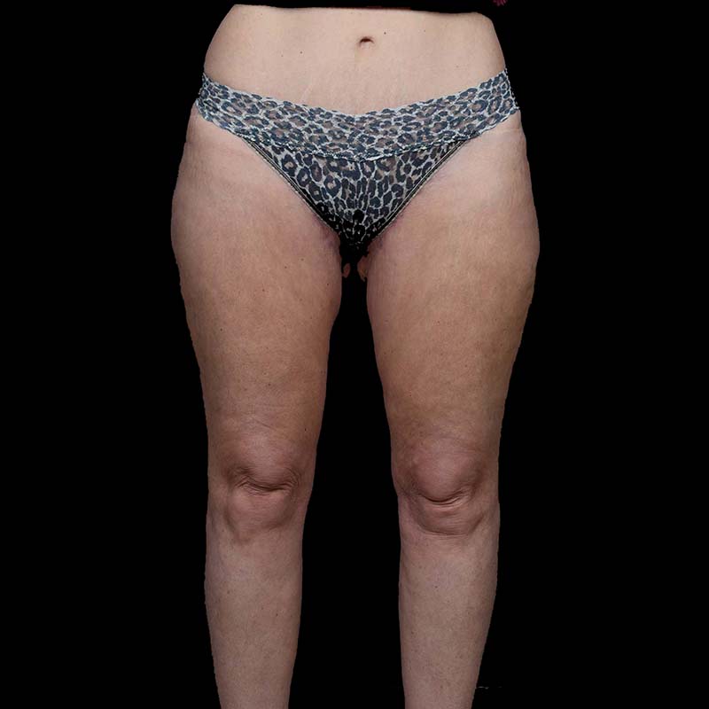 Thigh Lift Before & After Image