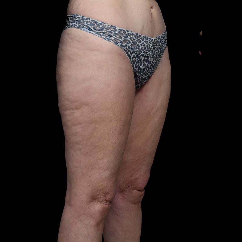 Thigh Lift Before & After Image