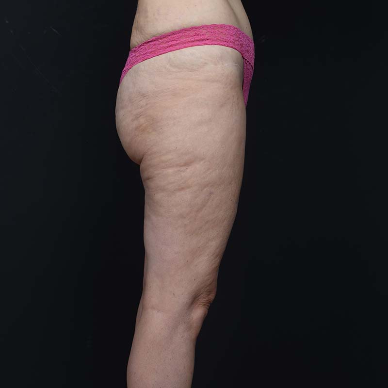 Thigh Lift Before & After Image