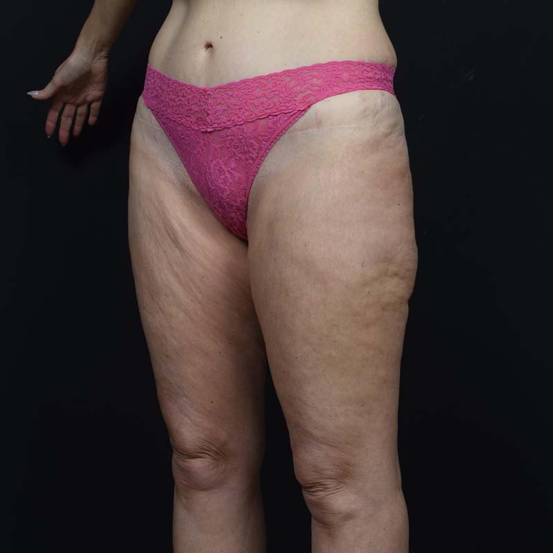 Thigh Lift Before & After Image