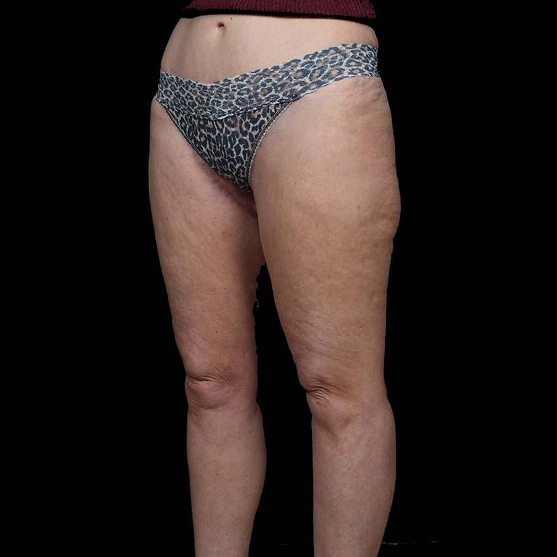 Thigh Lift Before & After Image