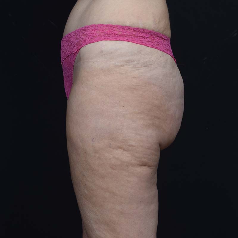 Thigh Lift Before & After Image