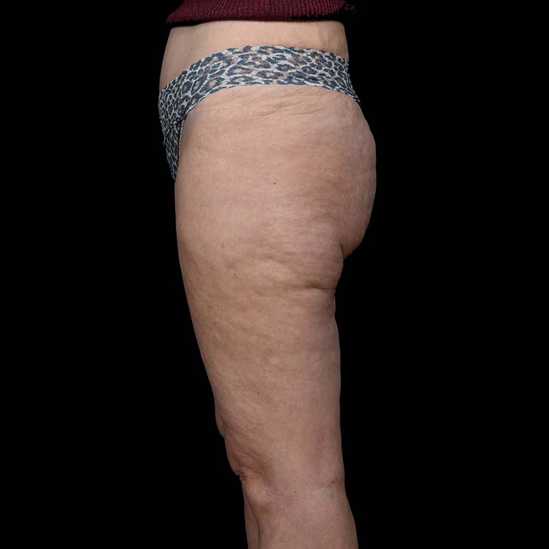 Thigh Lift Before & After Image