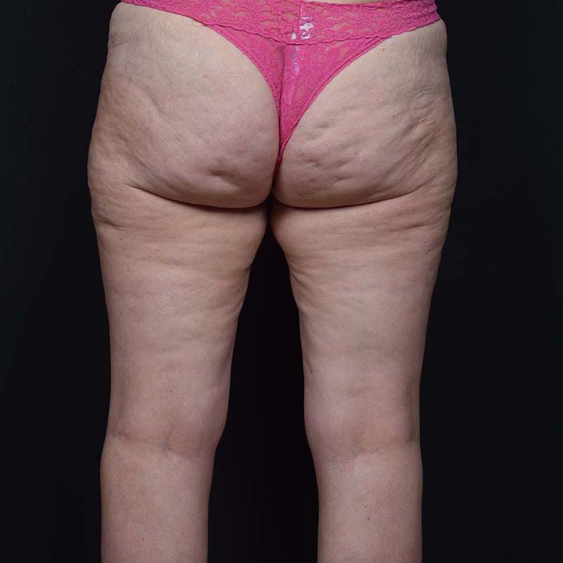 Thigh Lift Before & After Image