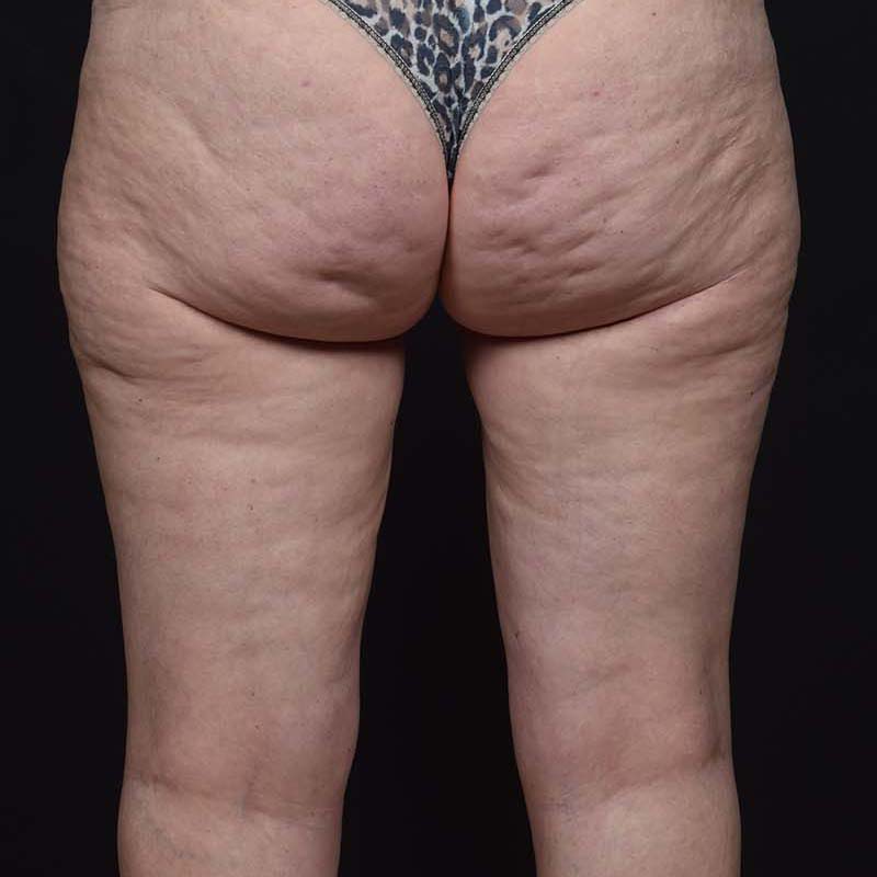 Thigh Lift Before & After Image