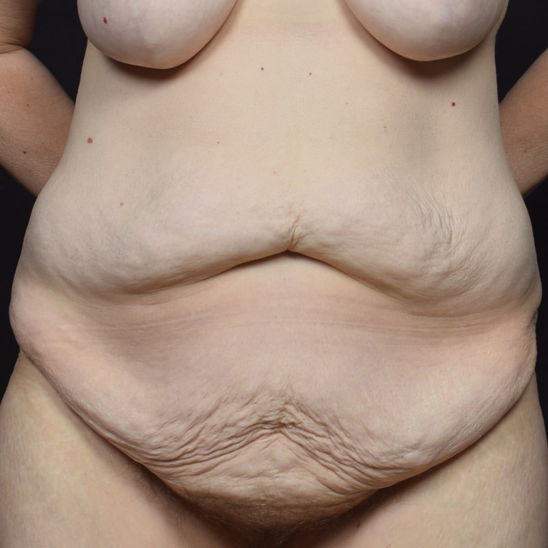 Tummy Tuck Before & After Image