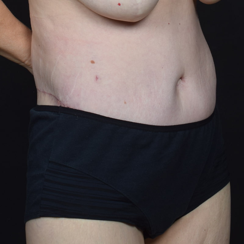 Tummy Tuck Before & After Image